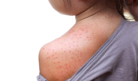 Himabihi / baby measles